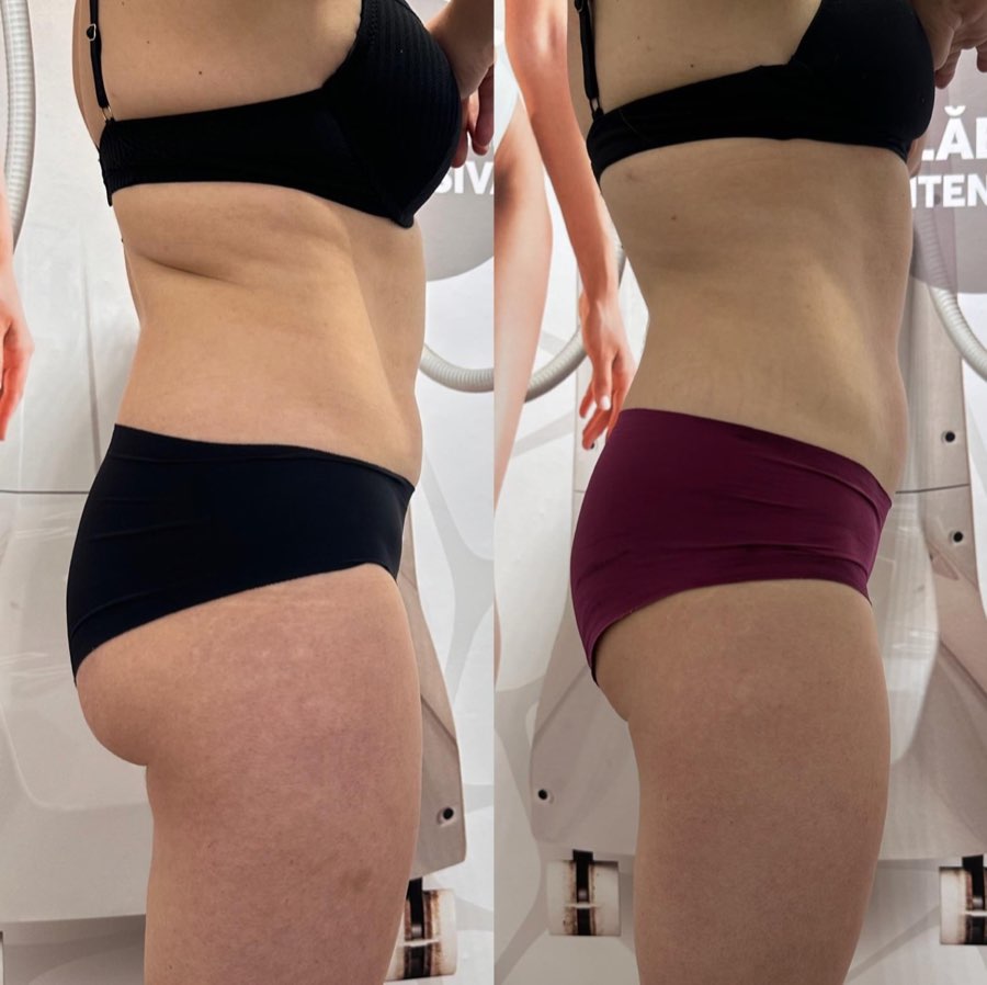 Comparatie before si after, vedere laterala